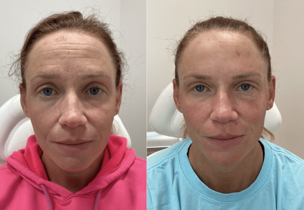 Botox Middleton before and after