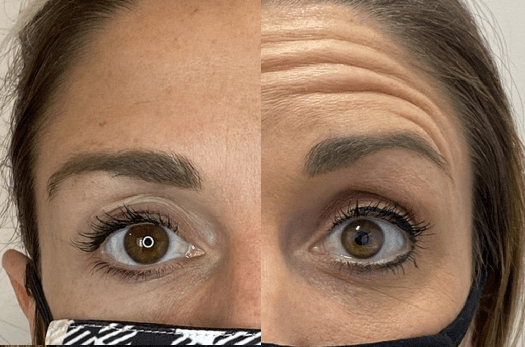 Botox before & after Madison, WI