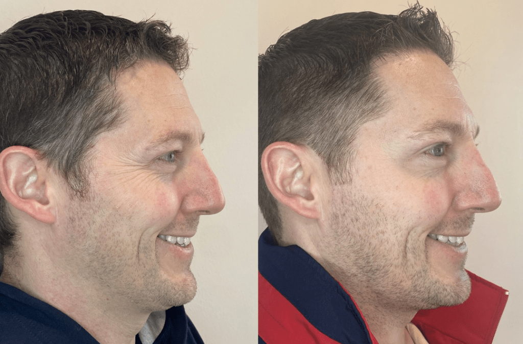 Botox before & after for men