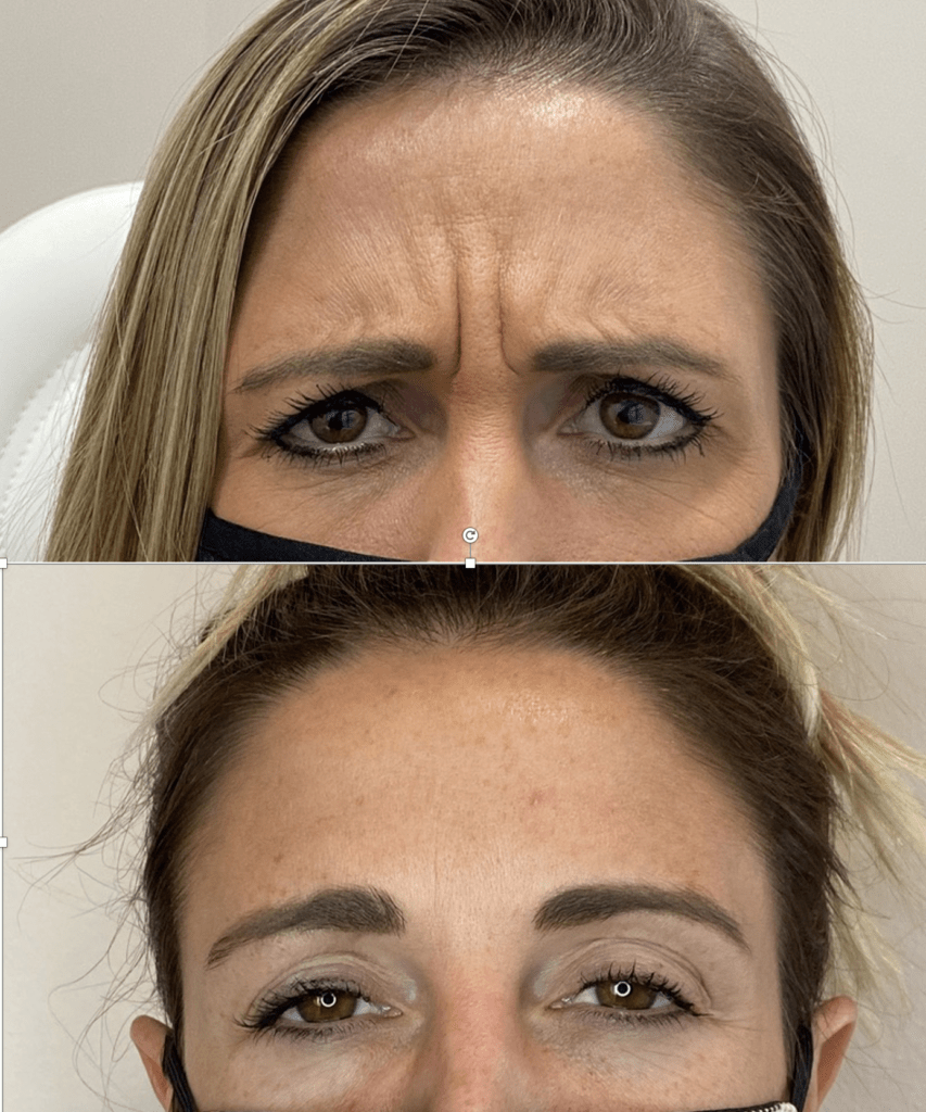 Botox® before and after