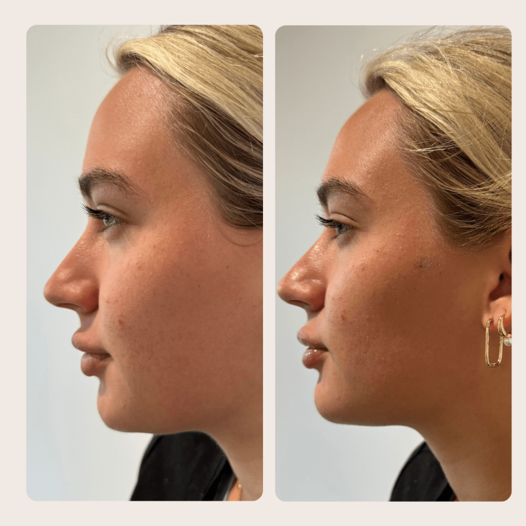 Facial balancing with dermal filler at BLUR Aesthetics in Madison WI
