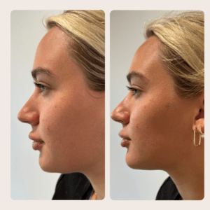Facial balancing with dermal filler at BLUR Aesthetics in Madison WI